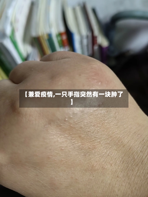 【兼爱疫情,一只手指突然有一块肿了】-第3张图片