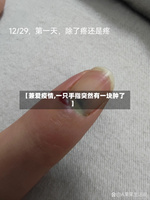 【兼爱疫情,一只手指突然有一块肿了】-第2张图片